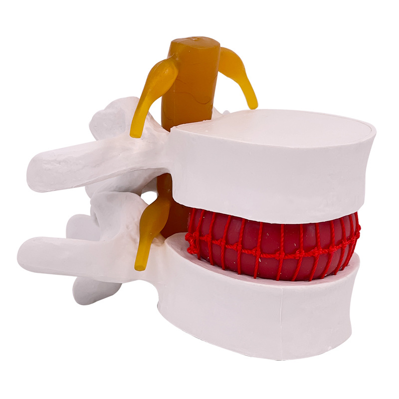 Picture of Lumbar model teaching medical human lumbar disc compression demonstration spinal bone extrusion pathology bone teaching aids