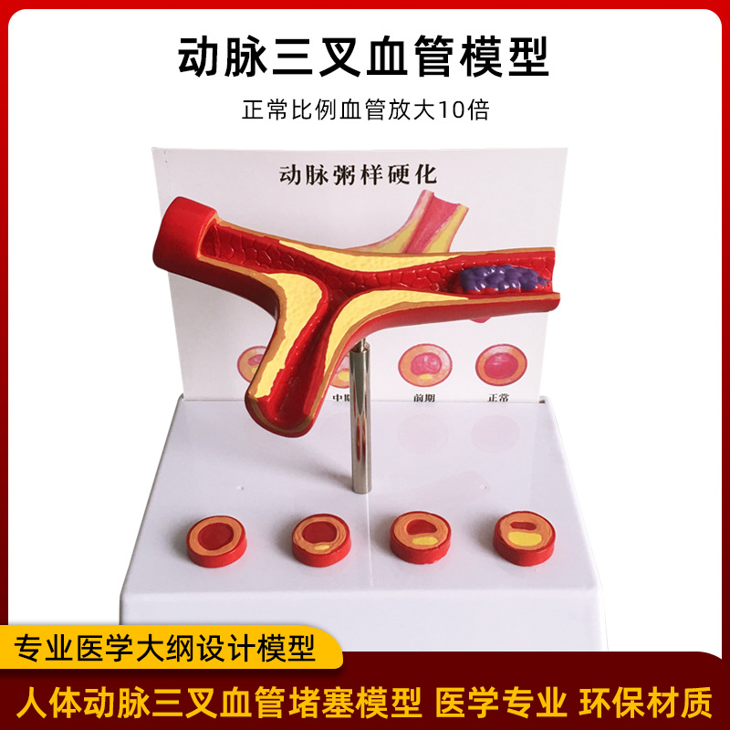 Picture of Coronary artery cardiovascular artery model Sclerosis model Human pathological model Thrombus model