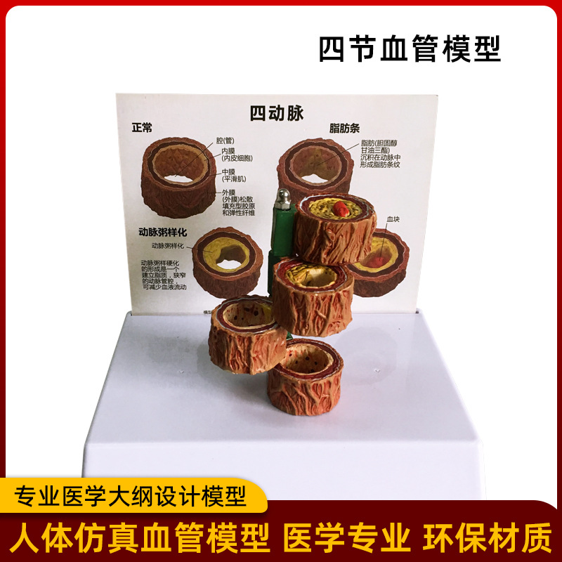 Picture of Coronary artery cardiovascular artery model Sclerosis model Human pathological model Thrombus model