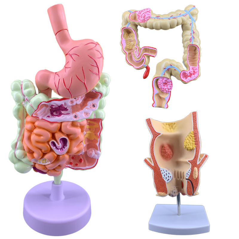 Picture of human large intestine pathological model gastrointestinal anatomy model pathological large intestine cecum rectum duodenal model