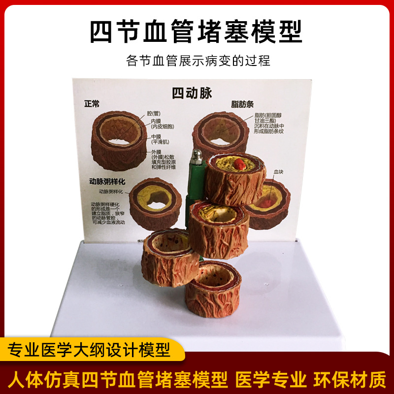 Picture of Coronary artery cardiovascular artery model Sclerosis model Human pathological model Thrombus model