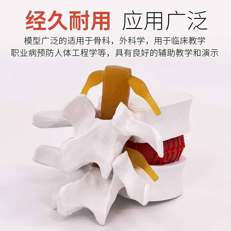 Picture of Lumbar model teaching medical human lumbar disc compression demonstration spinal bone extrusion pathology bone teaching aids