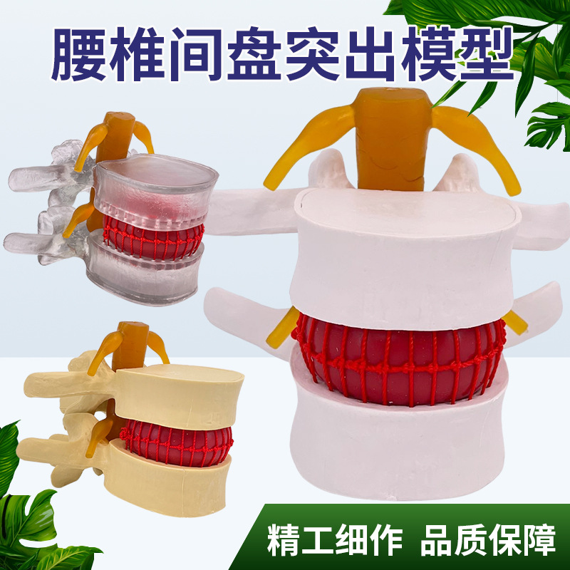 Picture of Lumbar model teaching medical human lumbar disc compression demonstration spinal bone extrusion pathology bone teaching aids