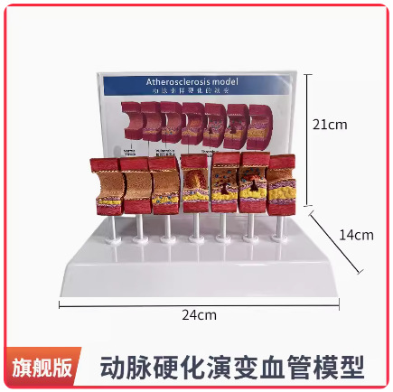 Picture of Coronary artery cardiovascular artery model Sclerosis model Human pathological model Thrombus model