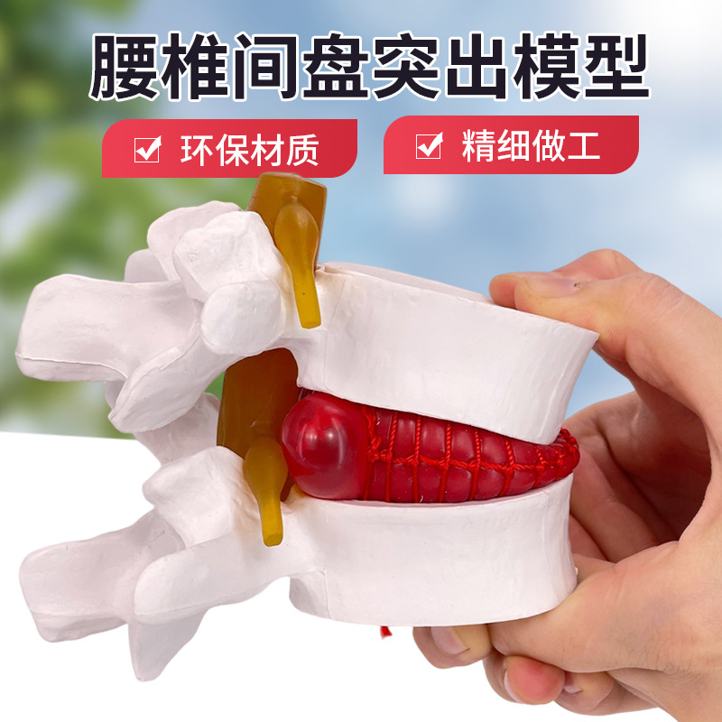Intervertebral disc model genuine goods medical human lumbar vertebra prominent spine spine pathology demonstration joint standard model