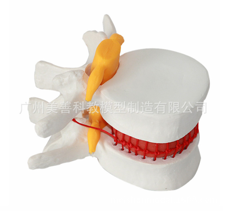Picture of Lumbar enlarged lumbar disc compression demonstration model human spine spine pathology demonstration Joint Medical use