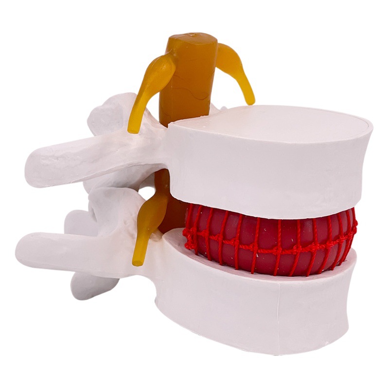 Picture of Lumbar model teaching medical human lumbar disc compression demonstration spinal bone extrusion pathology bone teaching aids