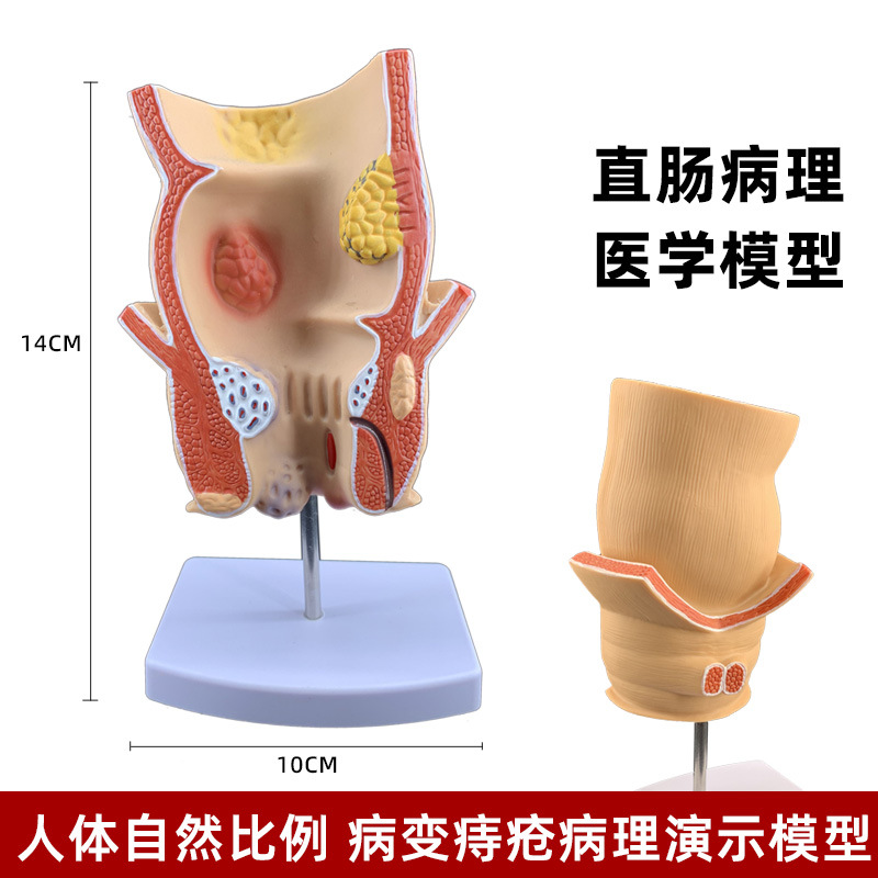 Picture of human large intestine pathological model gastrointestinal anatomy model pathological large intestine cecum rectum duodenal model