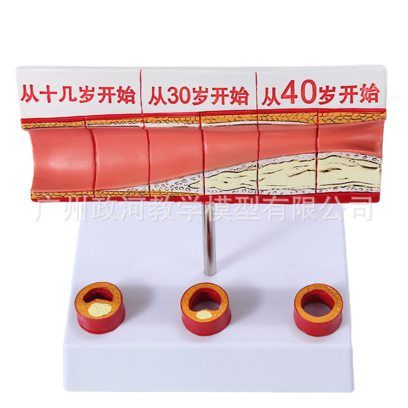 Picture of Coronary artery cardiovascular artery model Sclerosis model Human pathological model Thrombus model