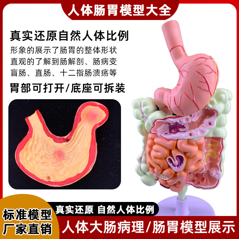 Picture of human large intestine pathological model gastrointestinal anatomy model pathological large intestine cecum rectum duodenal model