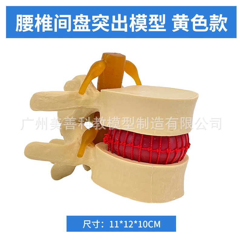 Picture of Lumbar model teaching medical human lumbar disc compression demonstration spinal bone extrusion pathology bone teaching aids