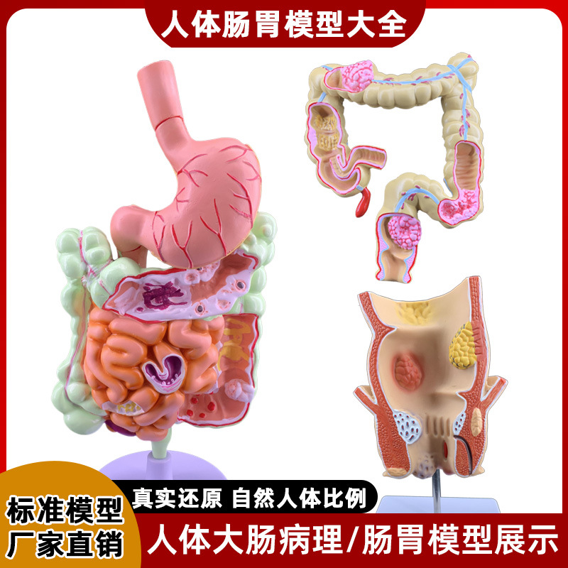 human large intestine pathological model gastrointestinal anatomy model pathological large intestine cecum rectum duodenal model