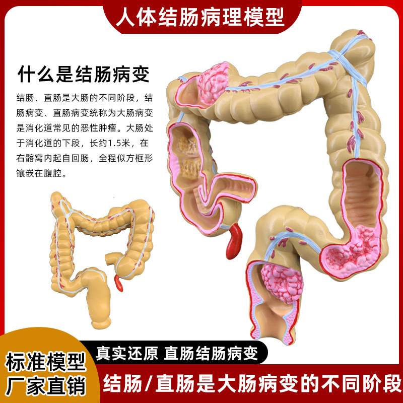 Picture of human large intestine pathological model gastrointestinal anatomy model pathological large intestine cecum rectum duodenal model