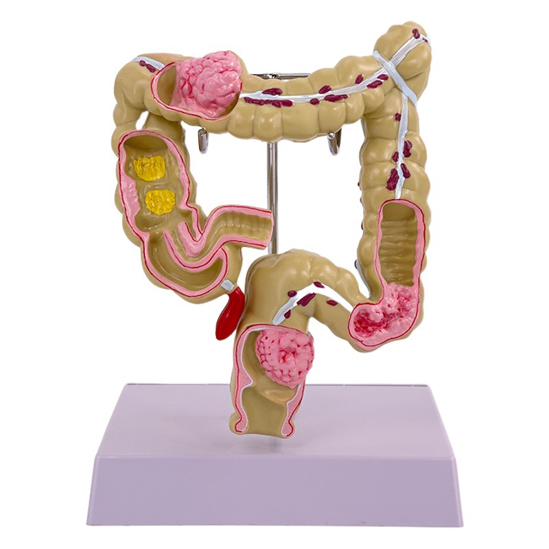 Large intestine pathological model gastrointestinal model large intestine pathological model intestinal disease human colon pathological model