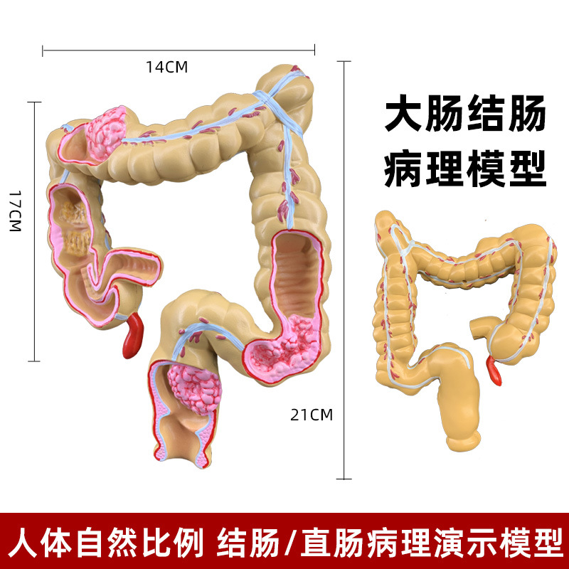 Picture of human large intestine pathological model gastrointestinal anatomy model pathological large intestine cecum rectum duodenal model