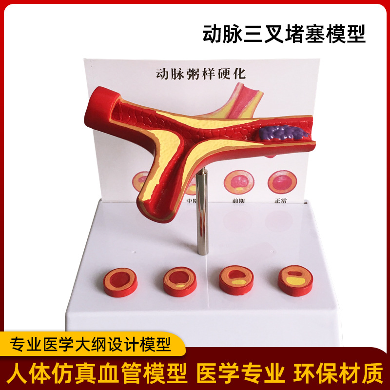 Picture of Coronary artery cardiovascular artery model Sclerosis model Human pathological model Thrombus model