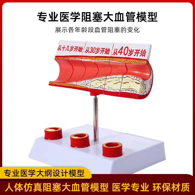 Picture of Coronary artery cardiovascular artery model Sclerosis model Human pathological model Thrombus model