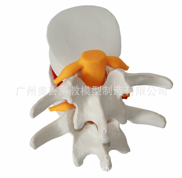 Picture of Lumbar enlarged lumbar disc compression demonstration model human spine spine pathology demonstration Joint Medical use