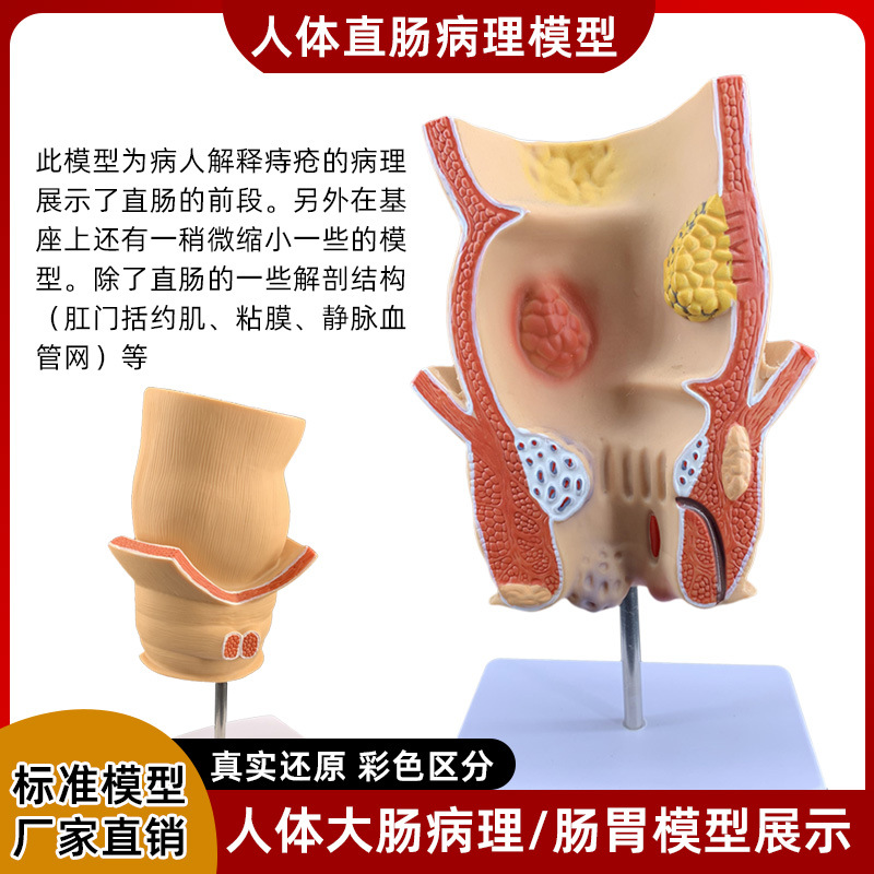 Picture of human large intestine pathological model gastrointestinal anatomy model pathological large intestine cecum rectum duodenal model
