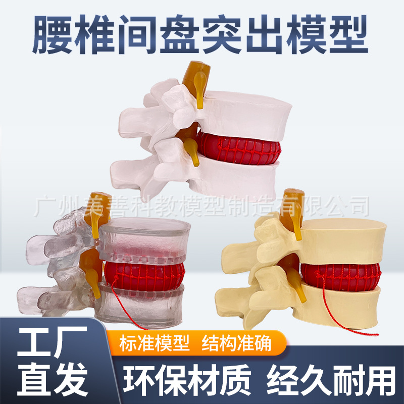 Medical Human Lumbar Disc Pressure Herniation Demonstration Model Spine Spine Joint Bone Pathology Side Pressure Model