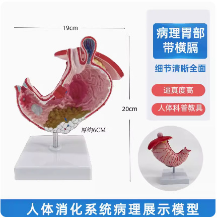 Picture of human large intestine pathological model gastrointestinal anatomy model pathological large intestine cecum rectum duodenal model