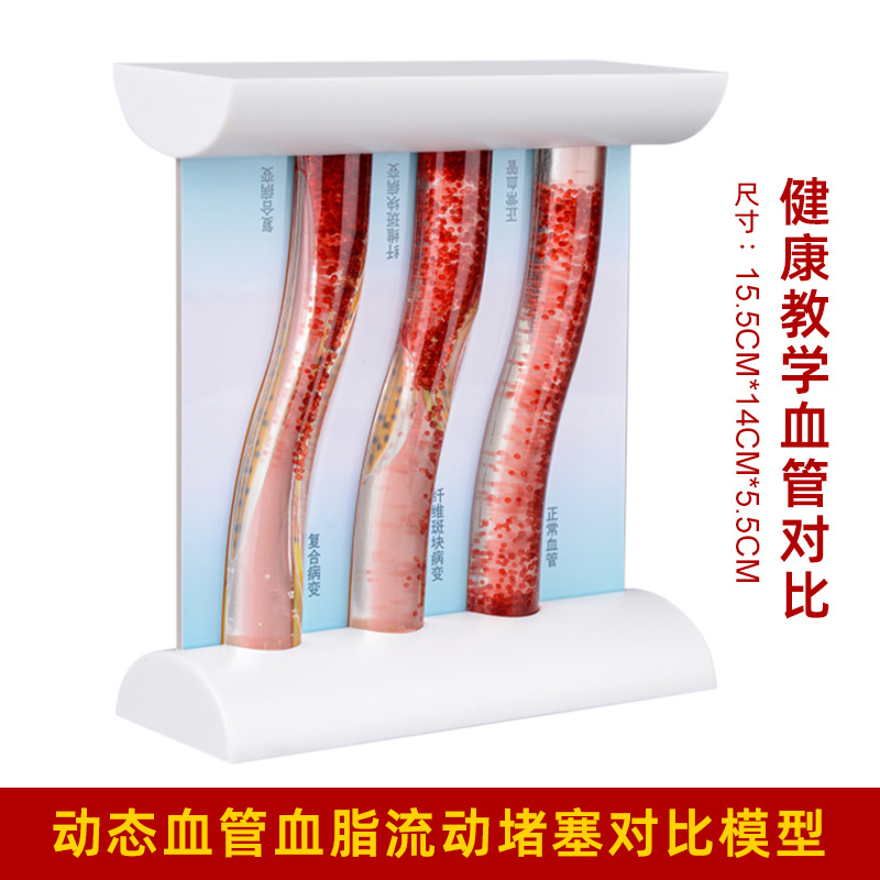 Picture of Coronary artery cardiovascular artery model Sclerosis model Human pathological model Thrombus model